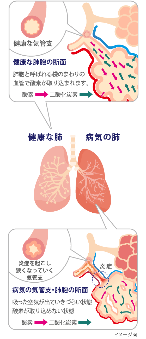 慢性 肺気腫